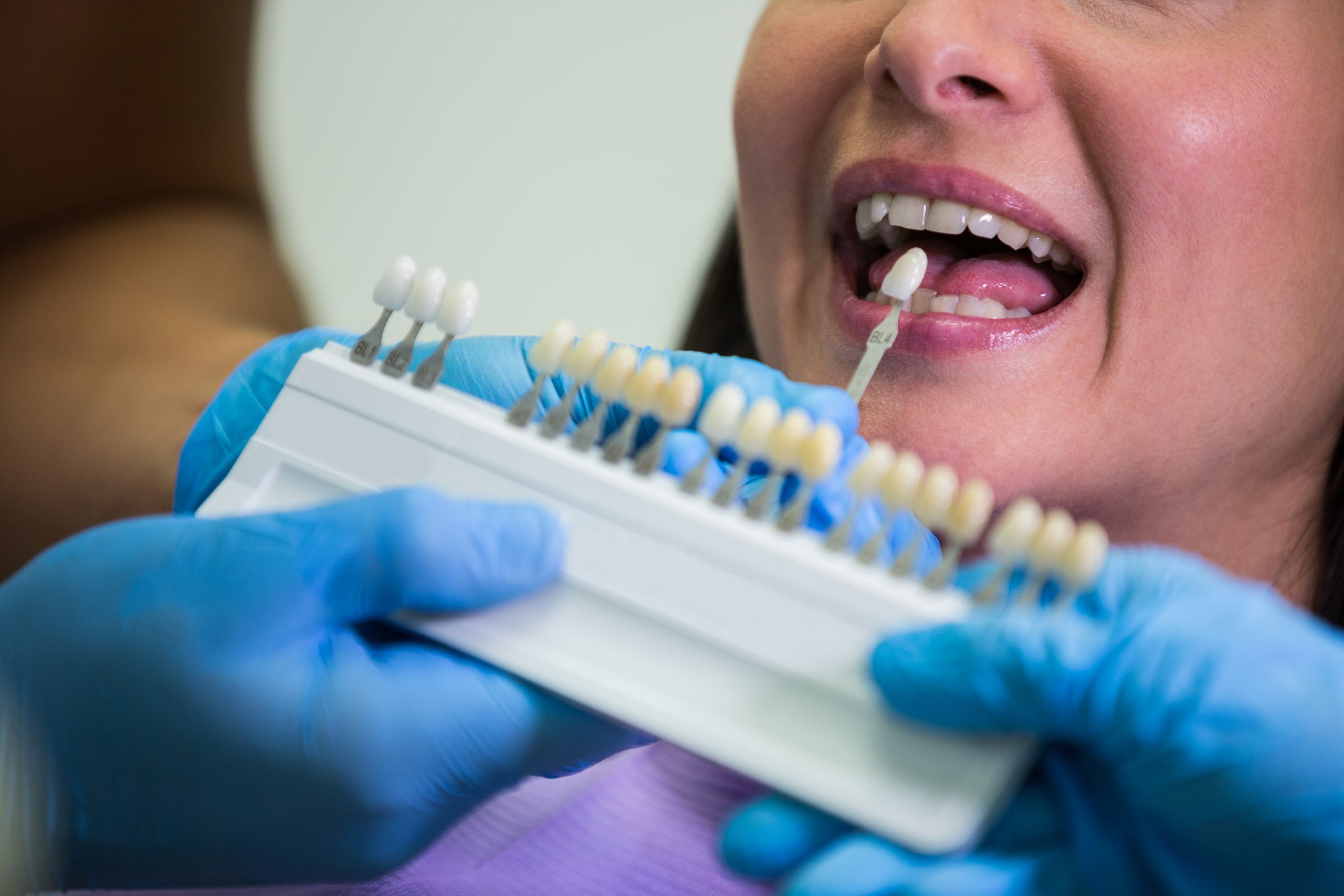 All About Dental Crowns: Types, Treatment Steps, and Maintenance.